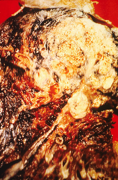 File:Cancerous lung.jpg