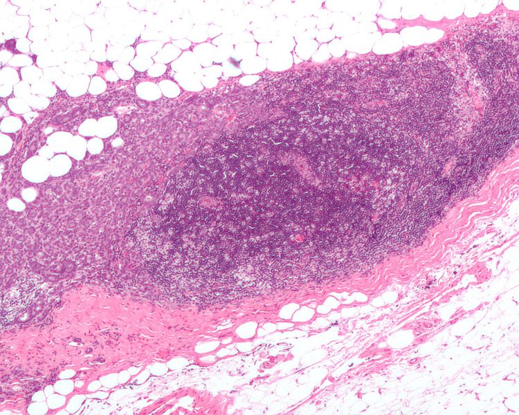 File:Breast carcinoma in a lymph node.jpg