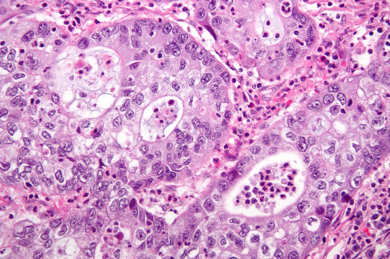 File:Adenosquamous carcinoma high mag.jpg